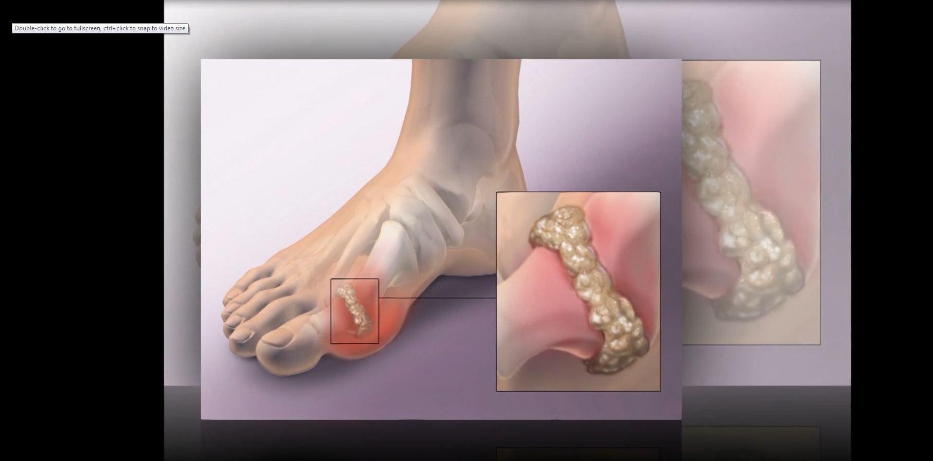 Nhịp cầu y tế- Dự phòng và điều trị bệnh Gout tái phát 24-08-2016