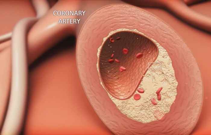 Nhịp cầu sức khỏe - Làm thế nào để phát hiện rối loạn mỡ máu 02-05-2018