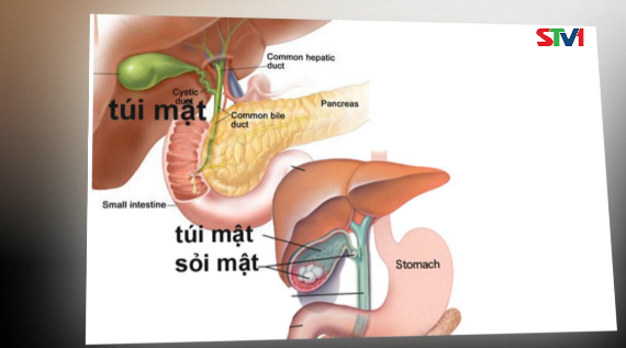Nhịp cầu y tế - Dự phòng và điều trị Ung thư Túi mật 19-08-2016