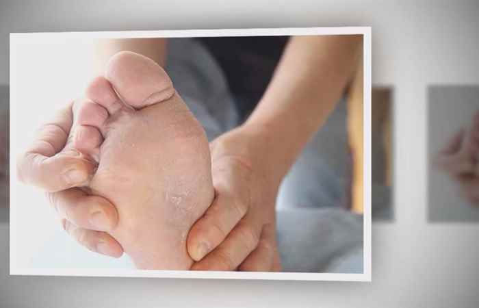 Sống khỏe 360 - Á sừng lòng bàn tay, bàn chân và cách xử lý (02-01-2021)