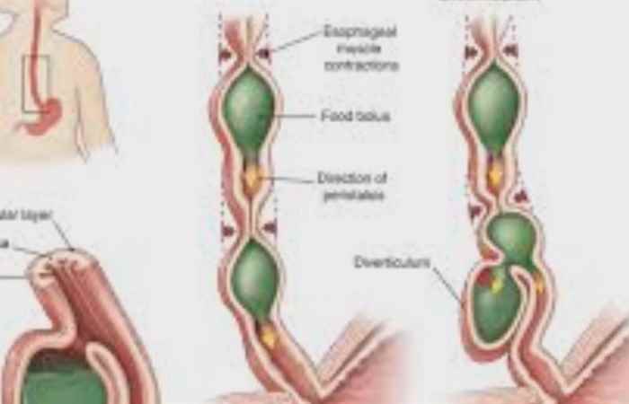 Sống khỏe 360 Túi thừa thực quản triệu chứng và cách điều trị (09-10-2019)