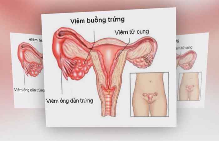Sống khỏe 360 -  Tìm hiểu về viêm phần phụ ở nữ giới (10-09-2019)