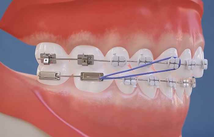 Sống khỏe 360 - Niềng răng ở trẻ em (26-12-2019)