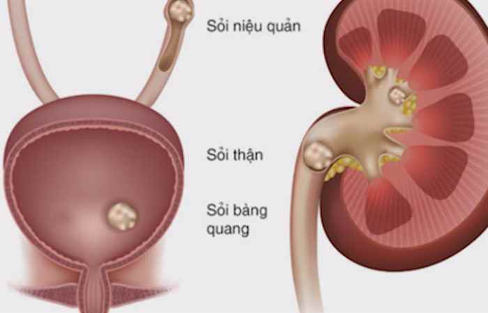 Sống khỏe 360 - Bệnh viêm bàng quang có lây không? (20-07-2020)