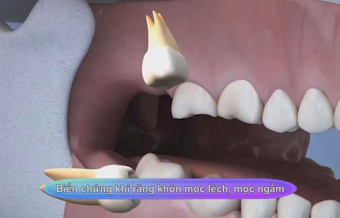 Sống khỏe 360 - Biến chứng khi răng khôn mọc lệch, mọc ngầm (08-12-2020)