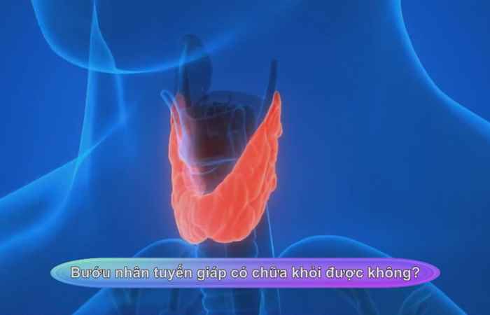 Sống khỏe 360 - Bướu nhân tuyến giáp có chữa khỏi được không (05-12-2020)