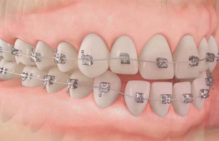 Sống khỏe 360 - Các hình thức thẩm mỹ răng (08-01-2020)