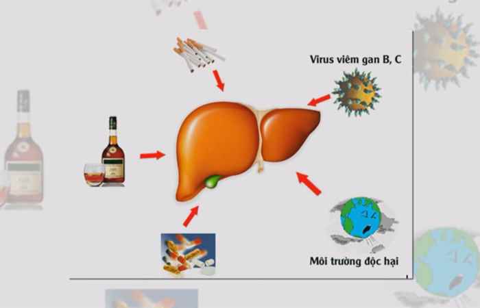 Sống khỏe 360 - Cách phòng chống bệnh xơ gan (27-04-2020)