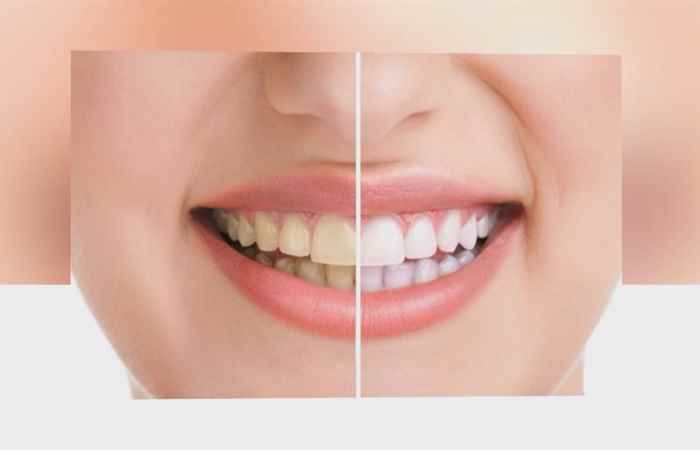 Sống khỏe 360 - Cảnh báo các bất thường về màu sắc của răng 06-01-2020