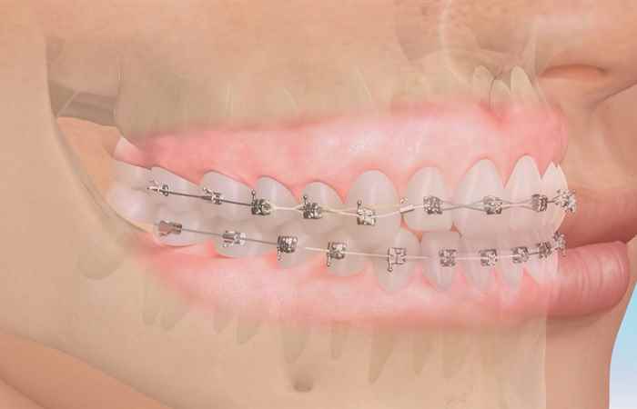 Sống khỏe 360 - Chỉnh nha cho người trưởng thành 04-10-2019