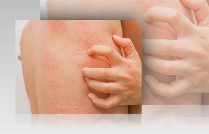 Sống khỏe 360 - Mè đay dị ứng và sai lầm là do gan (23-08-2020)