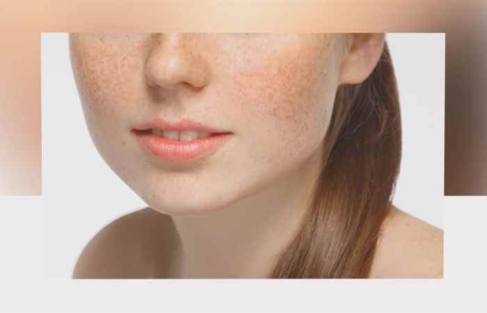 Sống khỏe 360 - Nám điều trị có hết được không? (26-06-2020)