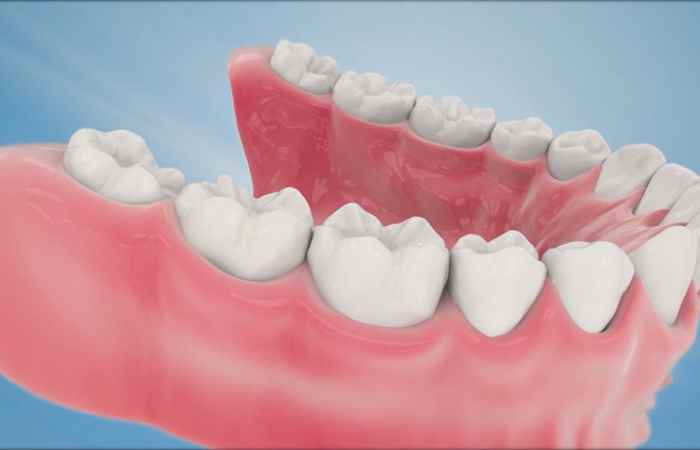 Sống khỏe 360 - Nên bọc răng sứ trong những trường hợp nào (24-12-2020)