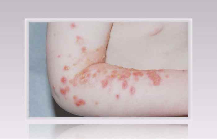 Sống khỏe 360 - Nhận biết dấu hiệu chốc mềm lây (13-11-2020)