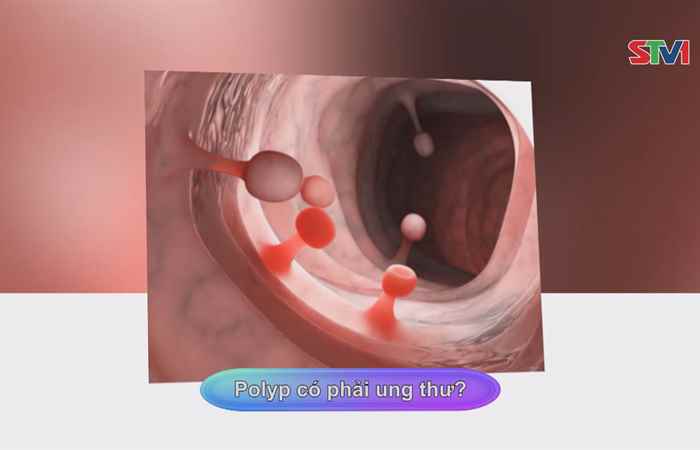 Sống khỏe 360 - Polyp có phải ung thư (14-06-2020)