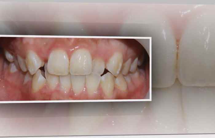 Sống khỏe 360 Răng vĩnh viễn mọc lệch 24-01-2019
