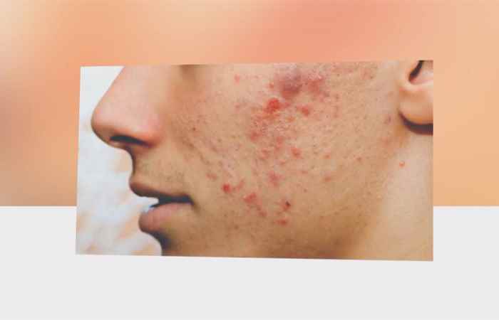 Sống khỏe 360 - Sai lầm hay mắc khi điều trị mụn trứng cá (12-06-2020)