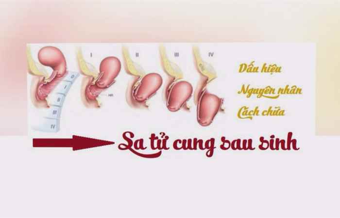 Sống khỏe 360 - Tại sao phụ nữ sau sinh thường bị sa tử cung (12-07-2020)