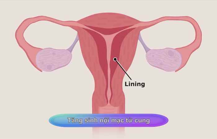 Sống khỏe 360 - Tăng sinh nội mạc tử cung (10-12-2020)