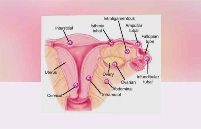 Sống khỏe 360 - Thai ngoài tử cung - Điều cơ bản cần biết (16-07-2020)