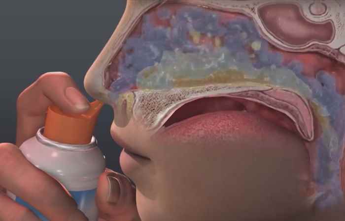 Sống khỏe 360 - Viêm xoang Trán có điều trị triệt để được không? (11-11-2020)
