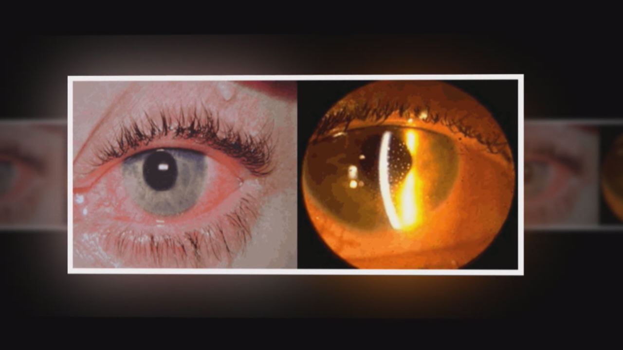 Nhịp cầu y tế - Điều trị bệnh Viêm mống mắt 18-11-2016