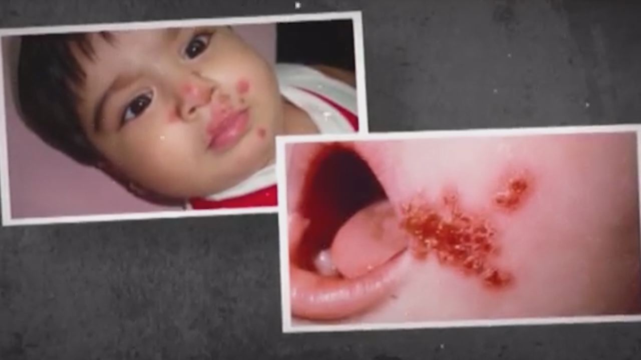 Nhịp cầu y tế - Dự phòng và điều trị bệnh chốc lở ở trẻ  29-11-2016