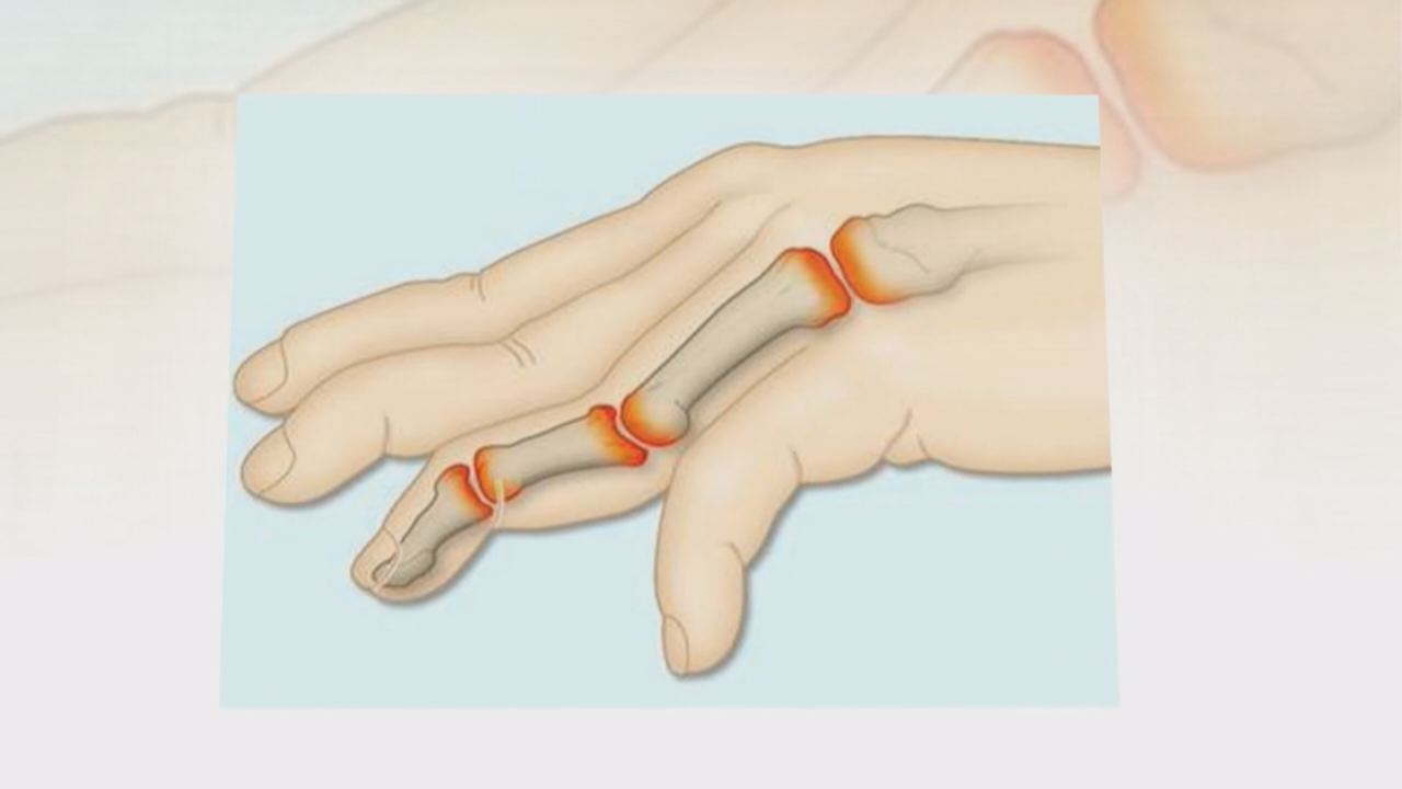 Nhịp cầu y tế 30-11-2016